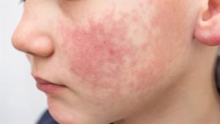 'Eκθεση ECDC: Ποιοι κινδυνεύουν περισσότερο από τον παρβοϊό [πίνακας]