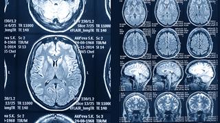 Φάρμακο για την παχυσαρκία έδειξε βιολογική επίδραση σε ανθρώπους με Alzheimer