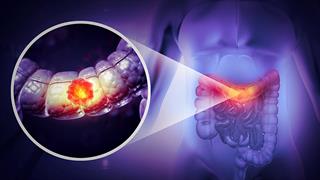 O FDA ενέκρινε θεραπευτική αγωγή για τον καρκίνο παχέος εντέρου