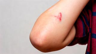 Αναπτύχθηκε ‘’έξυπνη’’ φορετή συσκευή παρακολούθησης επούλωσης πληγών