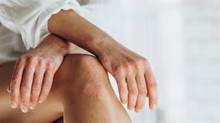 Ψωρίαση: Η αλλαγή βιολογικών φαρμάκων είναι αποτελεσματική σε πολλούς ασθενείς