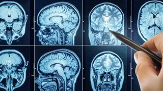 'Ογκος στον εγκέφαλο: Θεραπεία με πάγωμα των κυττάρων