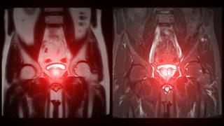 Οι ουρολογικοί καρκίνοι αυξάνονται: Τι δείχνουν οι έρευνες - Ποιό είναι το μήνυμα που πρέπει να κρατήσουμε