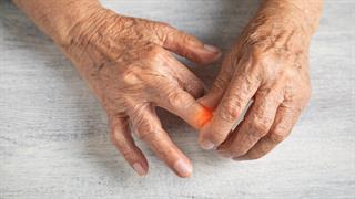 Προκαλεί αρθρίτιδα το τρίξιμο των δακτύλων;