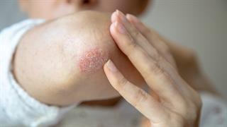 Tα οφέλη των αναστολέων της ιντερλευκίνης-17 στην ψωρίαση