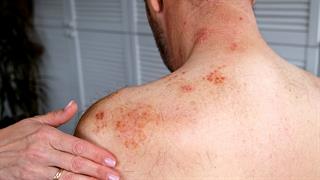 Νανοσωματίδιο κατά του έρπητα