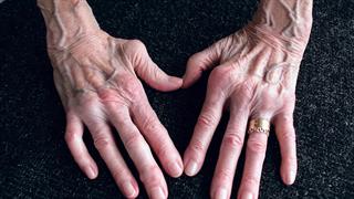 Φταίει το πρόωρα γερασμένο ανοσοποιητικό σύστημα για τη ρευματοειδή αρθρίτιδα;