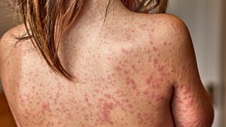 Ιλαρά: 7.000 κρούσματα στην Ευρώπη τον Σεπτέμβριο