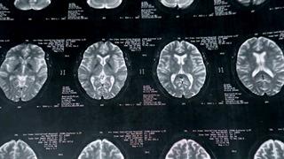 Πολλαπλή σκλήρυνση: Πώς βλάπτει τον εγκέφαλο χρόνια πριν την εμφάνιση συμπτωμάτων