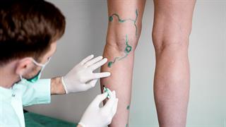 Γιατί πρέπει να χειρουργηθούν οι κιρσοί στα πόδια μου;