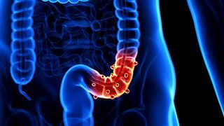 Εκκολπωμάτωση παχέος εντέρου: Παράγοντες κινδύνου και θεραπευτικές επιλογές