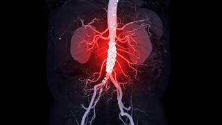 Γιατί χρειάζομαι επέμβαση καρδιάς ενώ δεν έχω κανένα σύμπτωμα