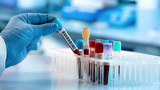 Νέα εξέταση αίματος εντοπίζει ανθρώπους που έχουν τριπλάσιο κίνδυνο για καρδιακή προσβολή