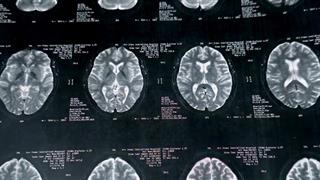 Η CNX Therapeutics αποκτά το Sativex από την Jazz Pharmaceuticals