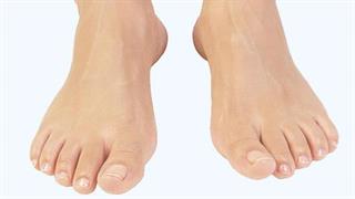 Γνωρίστε τους παράγοντες κινδύνου για ουρική αρθρίτιδα