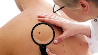 Εξελίξεις στη θεραπεία του μετασταστικού μελανώματος 