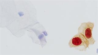 Roche: κυτταρολογικό τεστ με ευαισθησία στον καρκίνο του τραχήλου