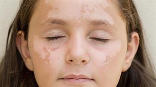 Ποιες παθήσεις του δέρματος επιδεινώνονται από τον ήλιο