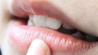 Άφθες στο στόμα: Αιτίες και θεραπεία