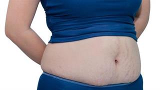 Πώς να απαλλαγείτε από τις ανεπιθύμητες ραγάδες