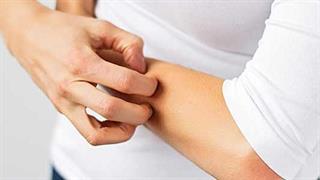 Ψωρίαση: Οι τραυματισμοί αυξάνουν τον κίνδυνο ψωριασικής αρθρίτιδας