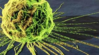 Νόσος του Πάρκινσον: Συνδέεται με 16 είδη καρκίνου 