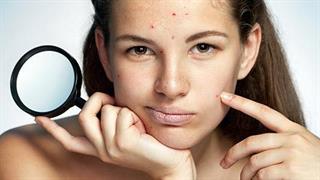 8 αλλαγές για να αντιμετωπίσετε την ακμή