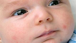 Εξάνθημα και ξηρή επιδερμίδα στα μωρά