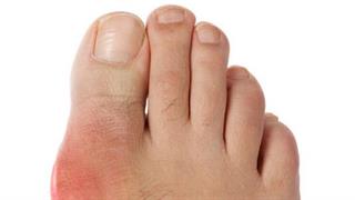 Έρευνα συνδέει την άπνοια ύπνου με έξαρση της ουρικής αρθρίτιδας 