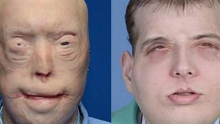 Αμερικανός πυροσβέστης υποβλήθηκε στην πιο εκτεταμένη μεταμόσχευση προσώπου έως σήμερα 