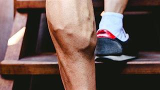 Κιρσοί - φλεβική ανεπάρκεια κάτω άκρων και εγκυμοσύνη