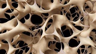 Μήπως κινδυνεύετε από οστεοπόρωση;