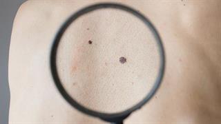 Οι ελιές στο δέρμα και οι κίνδυνοί τους