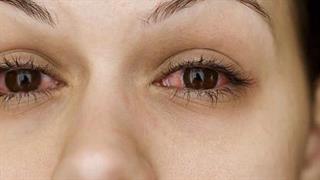23 Ιουλίου: Παγκόσμια Ημέρα του Sjogren