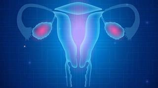 Καρκίνος των ωοθηκών: Αναπτύχθηκε τεστ για την πρόβλεψη του προσδόκιμου επιβίωσης