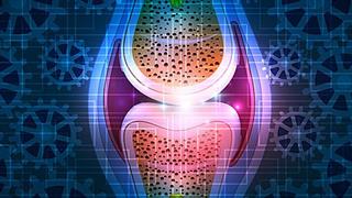 Οστεοπόρωση: Ο ρόλος του τρόπου ζωής 