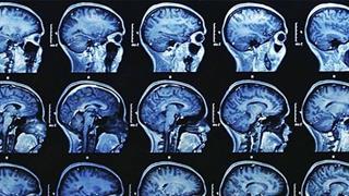 Η διάσειση συνδέεται με επιτάχυνση της έναρξης της νόσου Alzheimer σε ανθρώπους που κινδυνεύουν να την εμφανίσουν