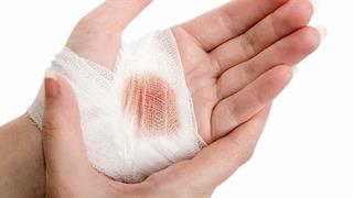 Κοπήκατε; Τα μικρόβια παραμονεύουν