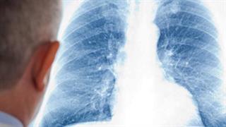 Καθολική Απαγόρευση Καπνίσματος για την αντιμετώπιση  της Χρόνιας Αποφρακτικής Πνευμονοπάθειας (ΧΑΠ)