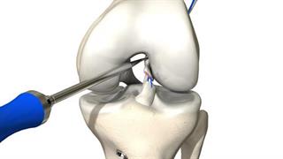 Πραγματοποιήθηκε η πρώτη επέμβαση Δυναμικής Ενδαρθρικής Σταθεροποίησης στη χώρα μας