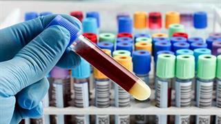 Βελτιώσεις από το υπουργείο Υγείας στη διάταξη για τα αιμοληπτήρια εκτός διαγνωστικών κέντρων