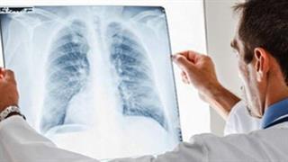 Οδηγίες ΚΕΕΛΠΝΟ προς υπεύθυνους ξενοδοχείων για τη νόσο των λεγεωνάριων ενόψει καλοκαιριού