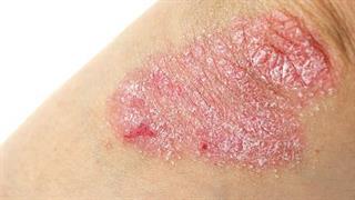 Σοβαρή ψωρίαση: Πιο ευάλωτοι οι άντρες έναντι των γυναικών