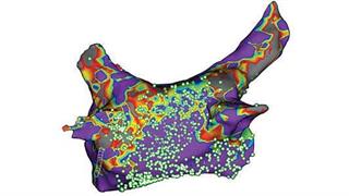 Νέο σύστημα καινοτόμου τεχνολογίας καρδιακής χαρτογράφησης στο Ωνάσειο