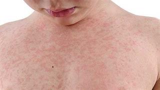 Επιδημία ιλαράς στην Ευρώπη