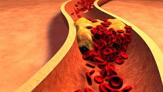 Οι κρύσταλλοι χοληστερόλης συνδέονται με την καρδιακή προσβολή