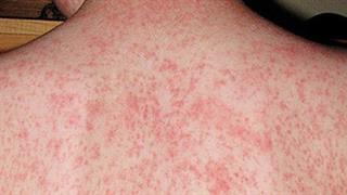 Υπαρκτός  κίνδυνος  έξαρσης ιλαράς στη χώρα μας