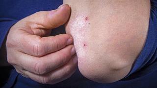 Πώς θα προλάβουμε τις εξάρσεις της ψωρίασης;