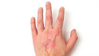 Ψωριασική Αρθρίτιδα: Mία νόσος με πολλά πρόσωπα