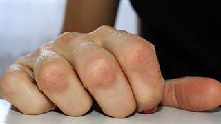 Ψωρίαση κατά πλάκας: Τι είναι και ποιοι παράγοντες προκαλούν την εμφάνισή της;